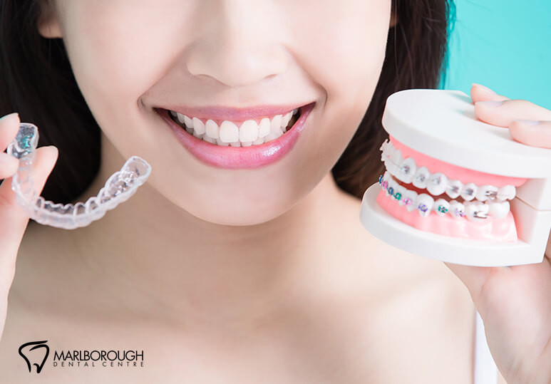 marlborough dental - blog - Invisalign or braces